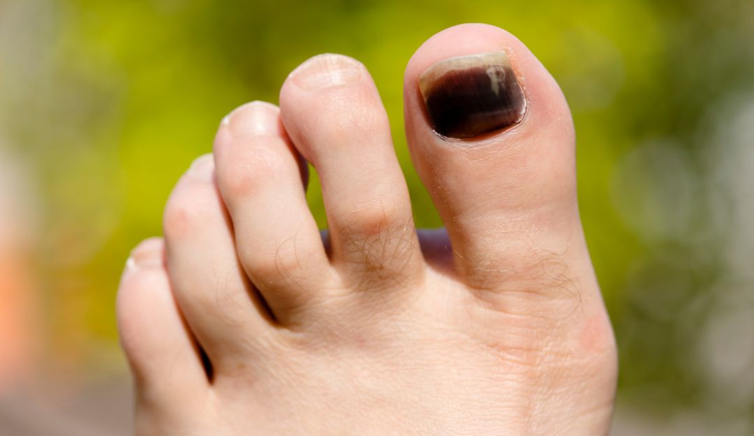 Kuku Kaki Menghitam Bisa Jadi Pertanda Gejala Penyakit Serius